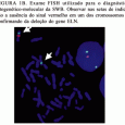 O exame de FISH ( Fluorescence in situ Hibridization =Hibridização in situ por Fluorscência) ainda é o padrão ouro de diagnóstico LABORATORIAL para a síndrome de Williams, ou seja para […]